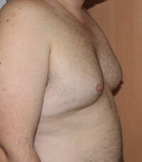 Gynecomastia