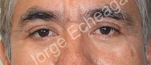 Eyelid Surgery Before and After Results