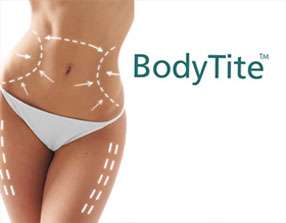 BodyTite treats the stomach, arms, knees and inner and outer thighs